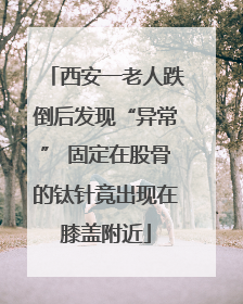 西安一老人跌倒后发现“异常” 固定在股骨的钛针竟出现在膝盖附近